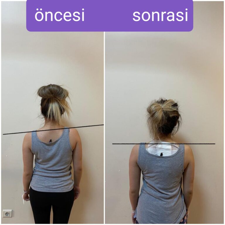 Skolyoz cerrahisi öncesi ve sonrası postür karşılaştırması