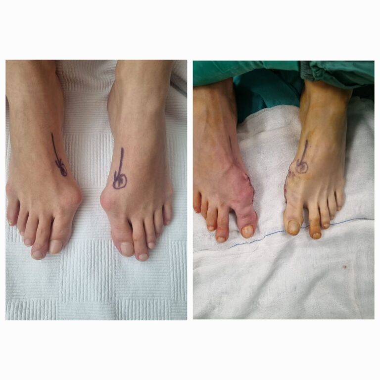 Ayak cerrahisi öncesi işaretleme ve sonrası görünüm