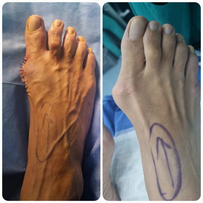 Ayak cerrahisi sonrası iyileşme süreci