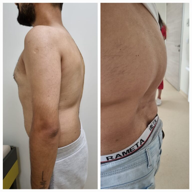 Skolyoz cerrahisi öncesi ve sonrası profil görünümü